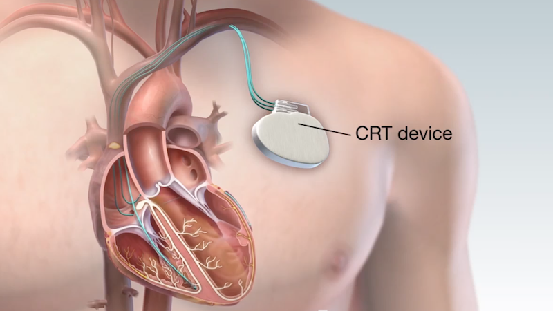 Best Doctor For Heart Bypass Surgery In Bangalore | Jayanagar | Dr. Srinivasa Prasad BV